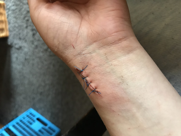 Genahte Wunde Rotung Normal Genaht Genahte Wunde Rotung Normal Genaht