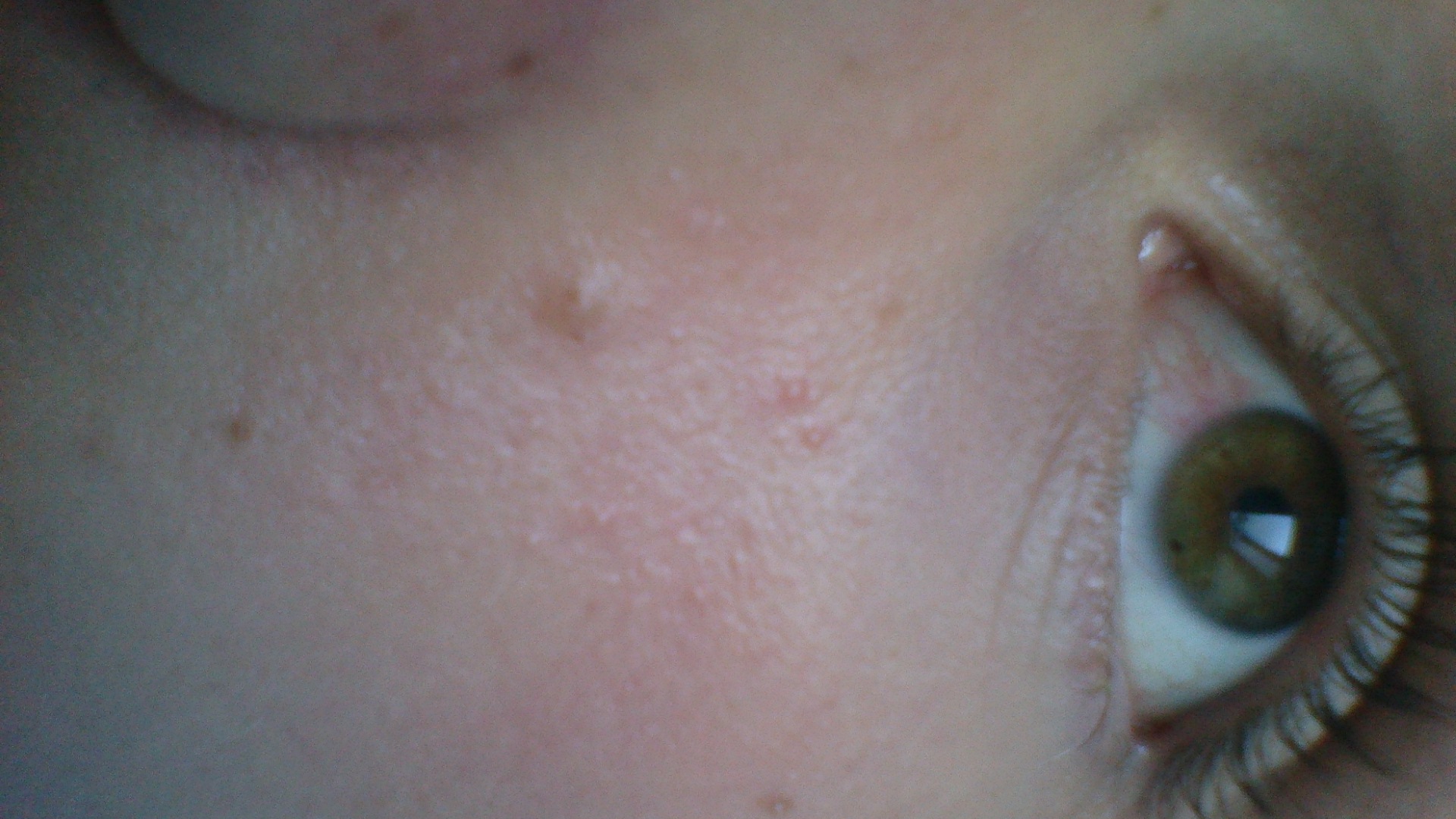 Geplatzt Adern im Auge (Medizin, Augen) Geplatzt Adern im Auge (Medizin, Augen)