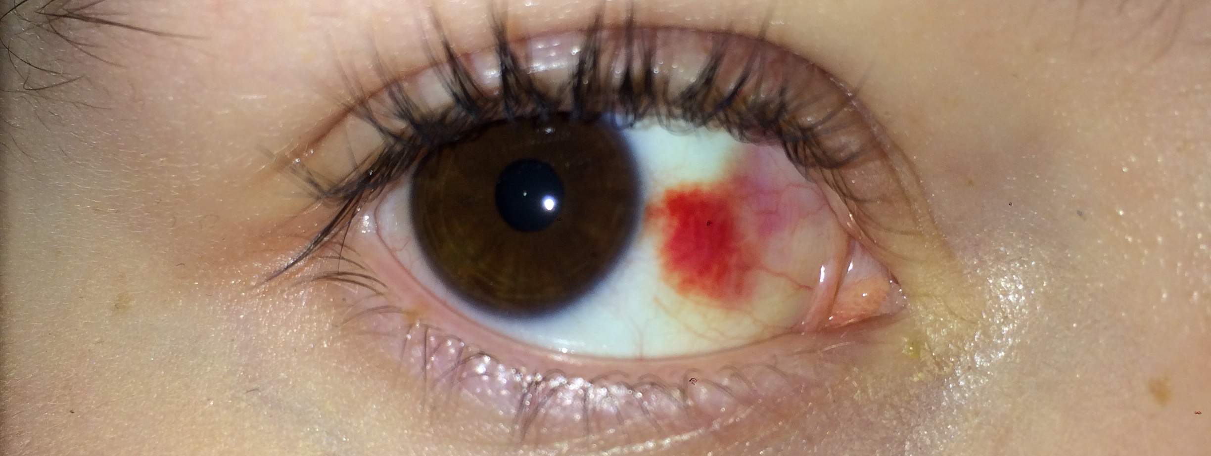 Geplatzte Ader im Auge oder etwas ernstes? (Augen) Geplatzte Ader im Auge oder etwas ernstes? (Augen)