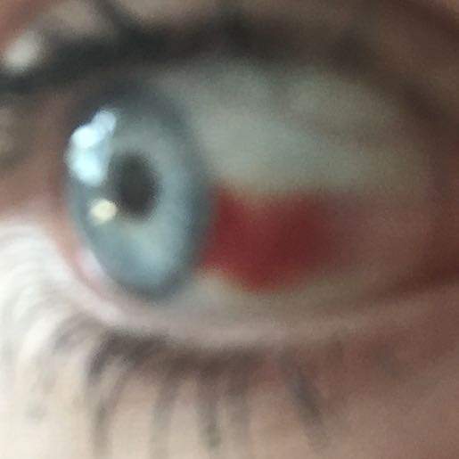 Geplatzte Ader im Auge, ohne äußeren Einfluss? (Arzt, Krankheit, Augen) Geplatzte Ader im Auge, ohne äußeren Einfluss? (Arzt, Krankheit, Augen)