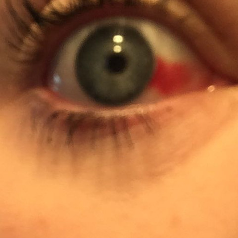 Geplatzte Ader Im Auge Ohne Ausseren Einfluss Arzt Krankheit Augen Geplatzte Ader Im Auge Ohne Ausseren Einfluss Arzt Krankheit Augen