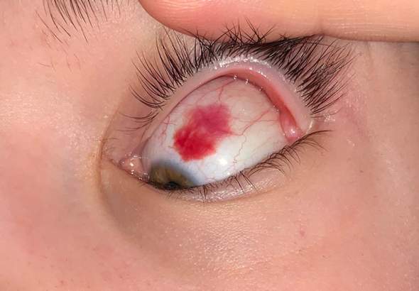 Geplatzte Adern im Auge oder was ist das? (Gesundheit und Medizin
