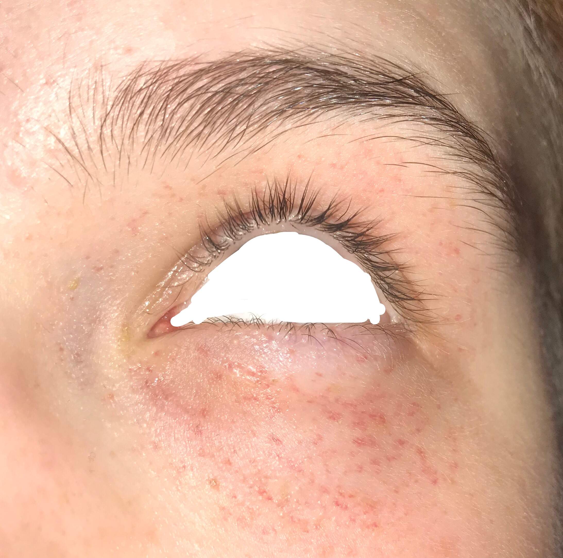 Geplatzte Adern unter dem Auge? (Gesundheit und Medizin, Gesundheit, Arzt)