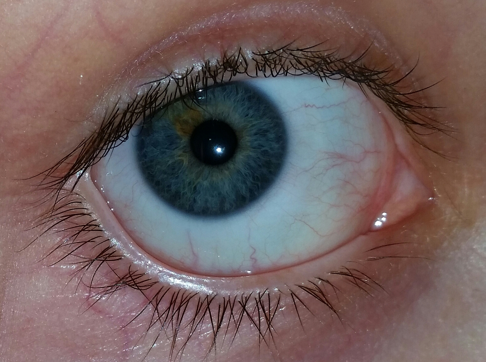 Gerötete Augen- Ursache?