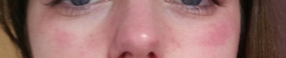 Gerotete Heisse Schwellung Unter Den Augen Haut Hautprobleme Jochbein Gerotete Heisse Schwellung Unter Den Augen Haut Hautprobleme Jochbein