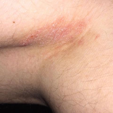 Gerotete Juckende Stelle Medizin Arzt Haut