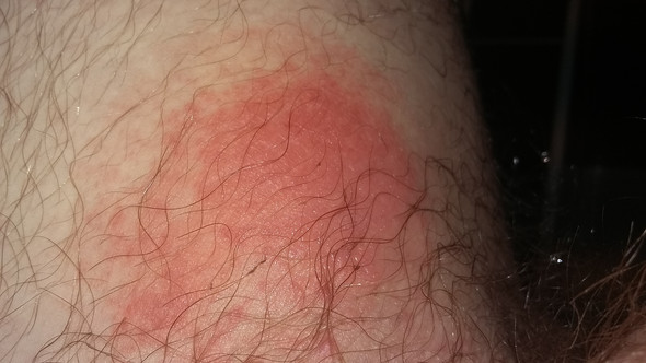 Gerotete Stelle Am Oberschenkel Neben Hoden Gesundheit Haut