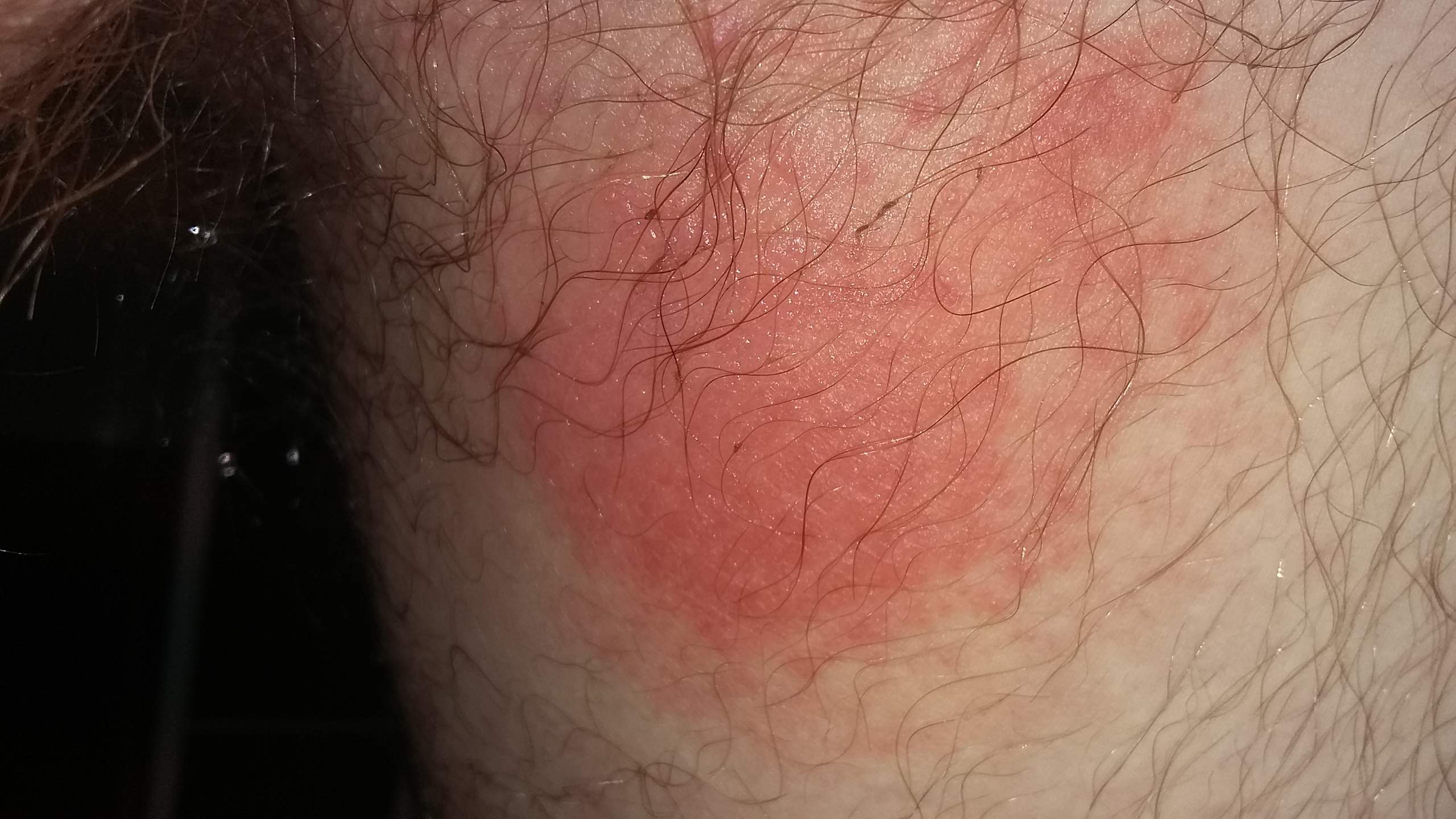 Hodensack roter Hodenentzündung: Symptome,
