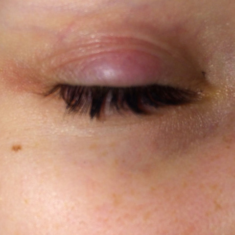 Gerstenkorn Was Tun Damit Dieser Schneller Verheilt Augen Gerstenkorn Was Tun Damit Dieser Schneller Verheilt Augen