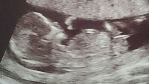 Ultraschall anzeichen oder junge Geschlecht Baby