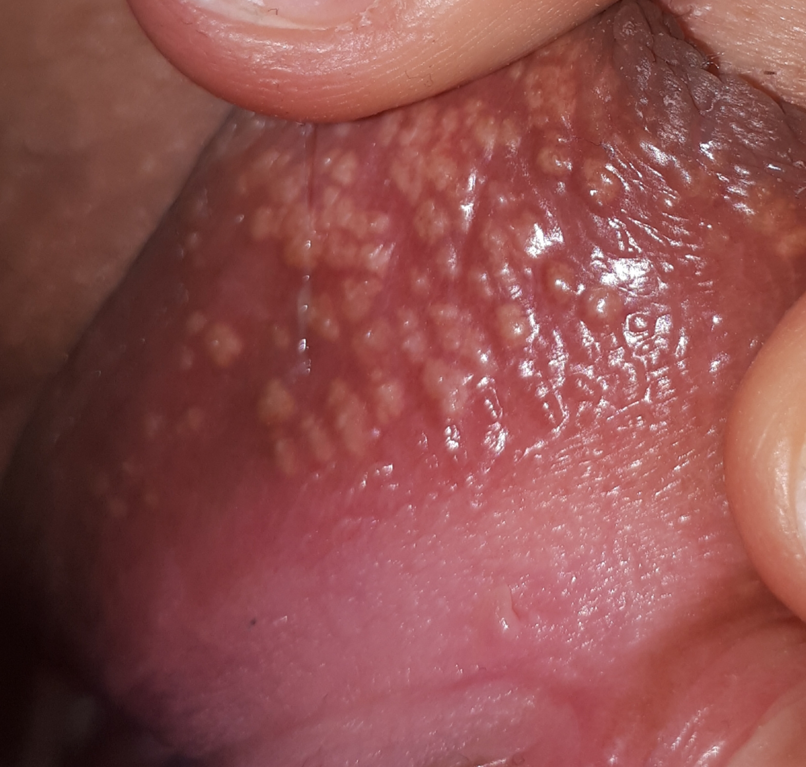 Geschlechtskrankheit Feigwarzen Trd Jungfrau Gesundheit Medizin Sexualitat Geschlechtskrankheit Feigwarzen Trd Jungfrau Gesundheit Medizin Sexualitat