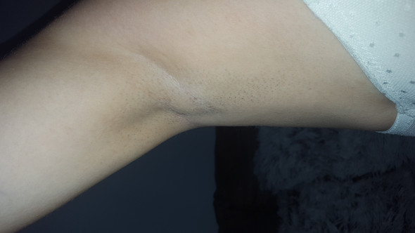 46+ Pickel Unter Der Haut Achselhöhle Gif