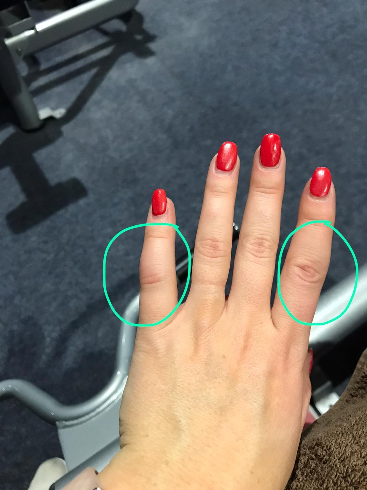 Geschwollene Finger Im Winter Warum