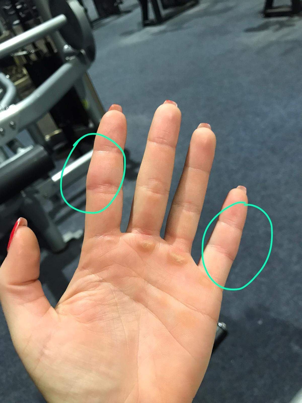 Geschwollene Finger im Winter warum?