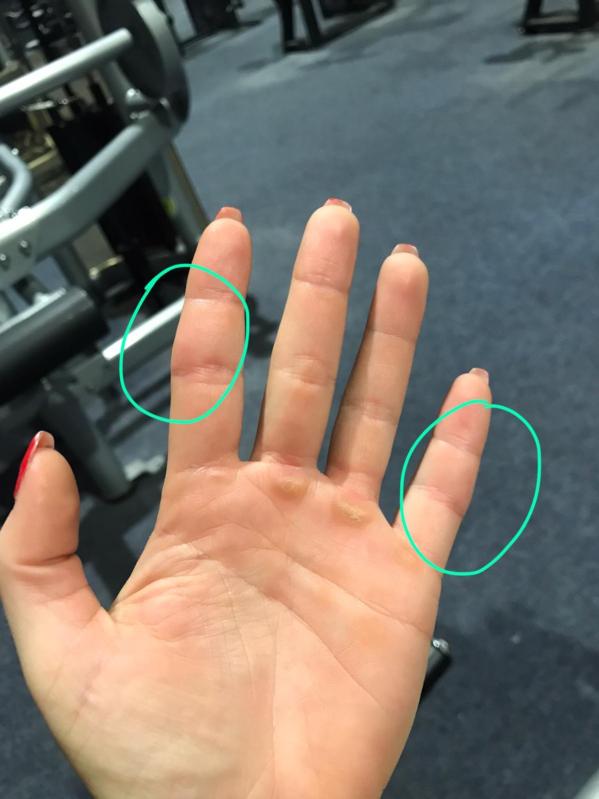 Geschwollene Finger im Winter warum?