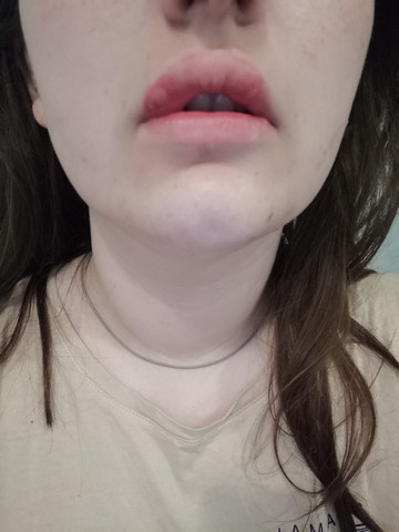 Lippen geschwollene geschwollene lippen