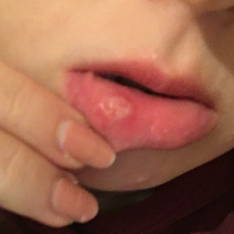 Download Pickel An Der Lippe Innen Pictures