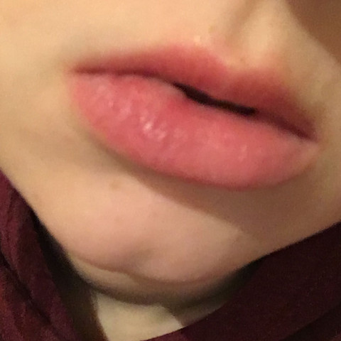 Lippe gebissen geschwollen