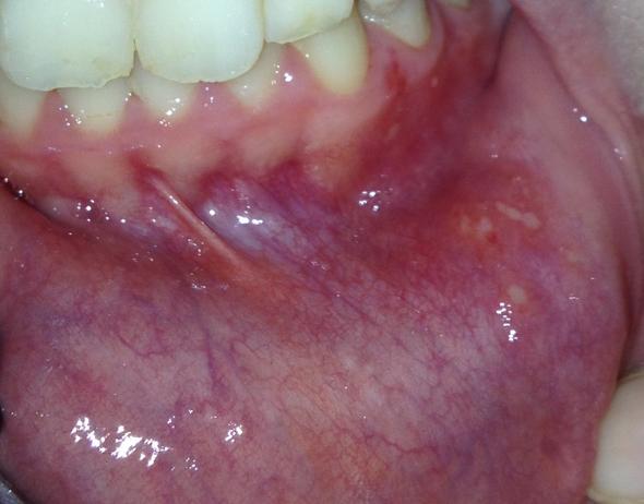 Geschwollene Lippeninnenseite mit weißen Punkten . Sind das Apthen