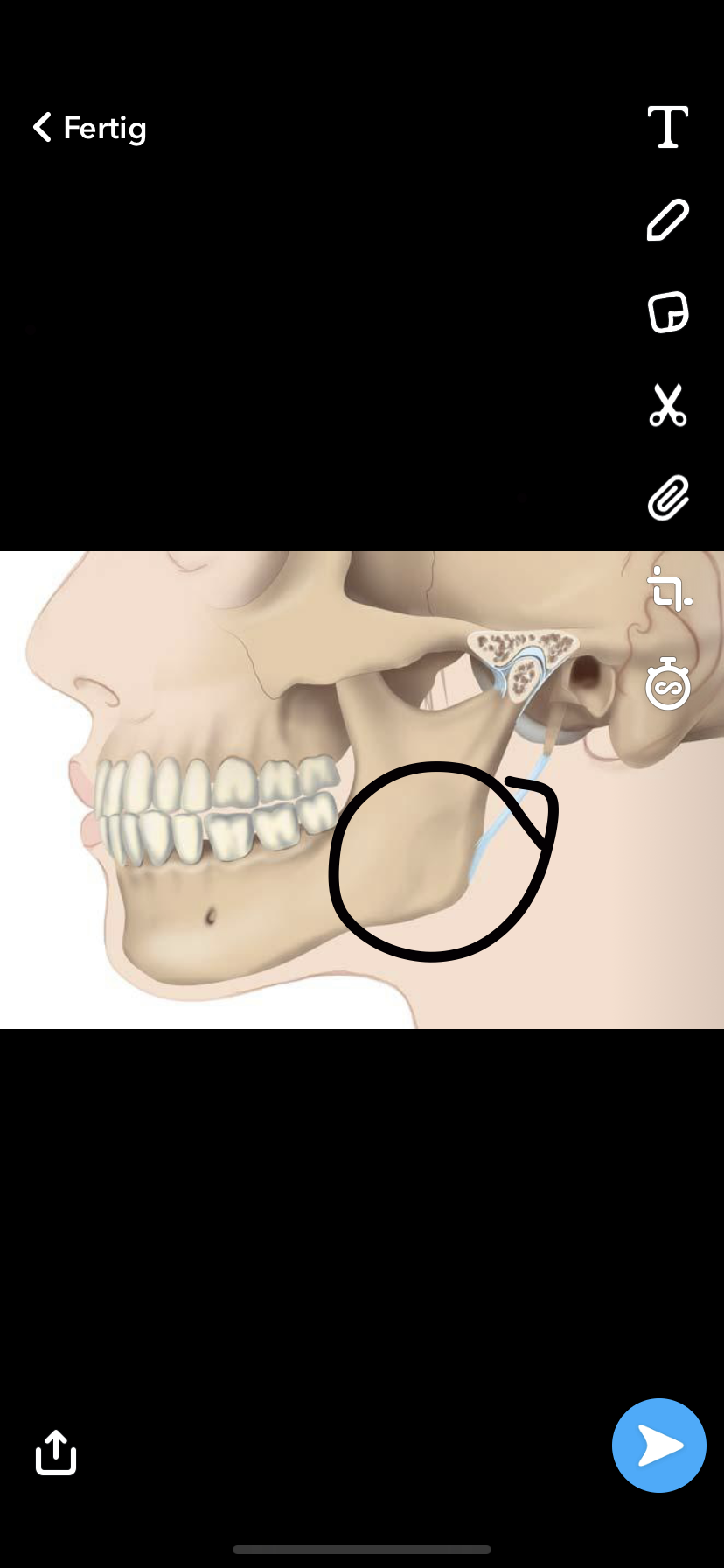 Geschwollene lymphknoten ( Bild )? (Gesundheit und Medizin, Gesundheit