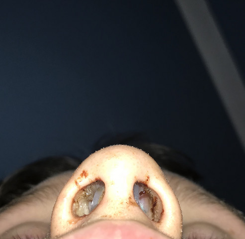 Geschwollene Nase Von Op Gesundheit Und Medizin Nasen Op Geschwollene Nase Von Op Gesundheit Und Medizin Nasen Op