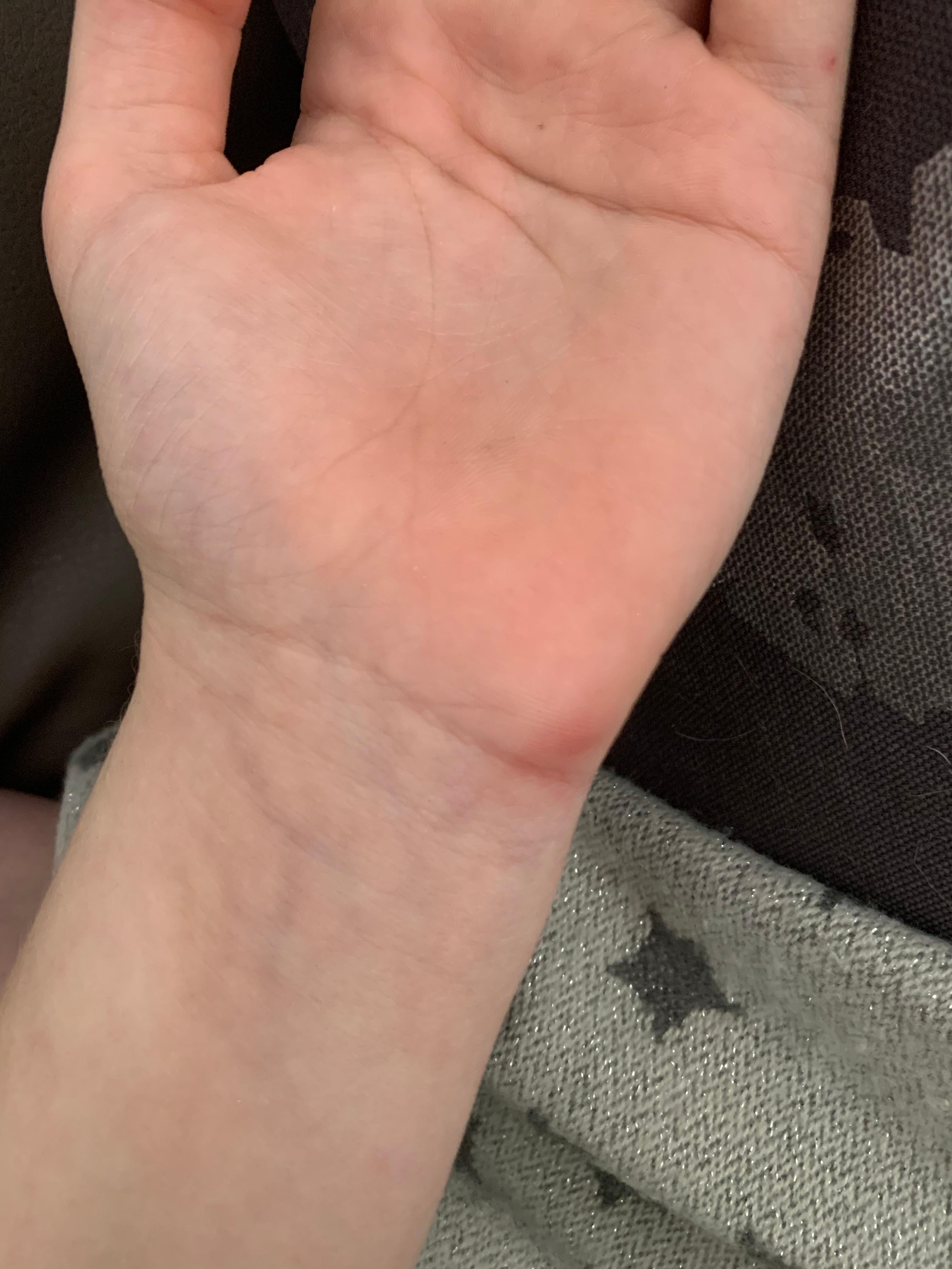 Geschwollene Stelle An Hand Nach Bad Gesundheit Und Medizin Gesundheit Schwellung Geschwollene Stelle An Hand Nach Bad Gesundheit Und Medizin Gesundheit Schwellung