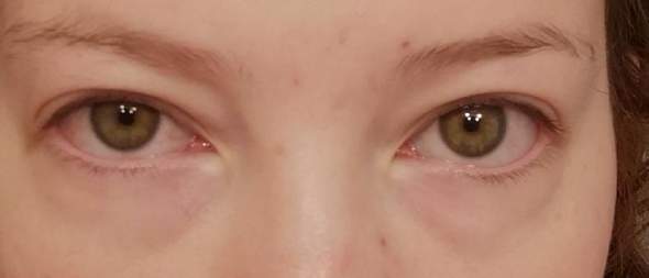 Geschwollene Und Rote Augen Am Morgen Gesundheit Und Medizin Geschwollene Augen