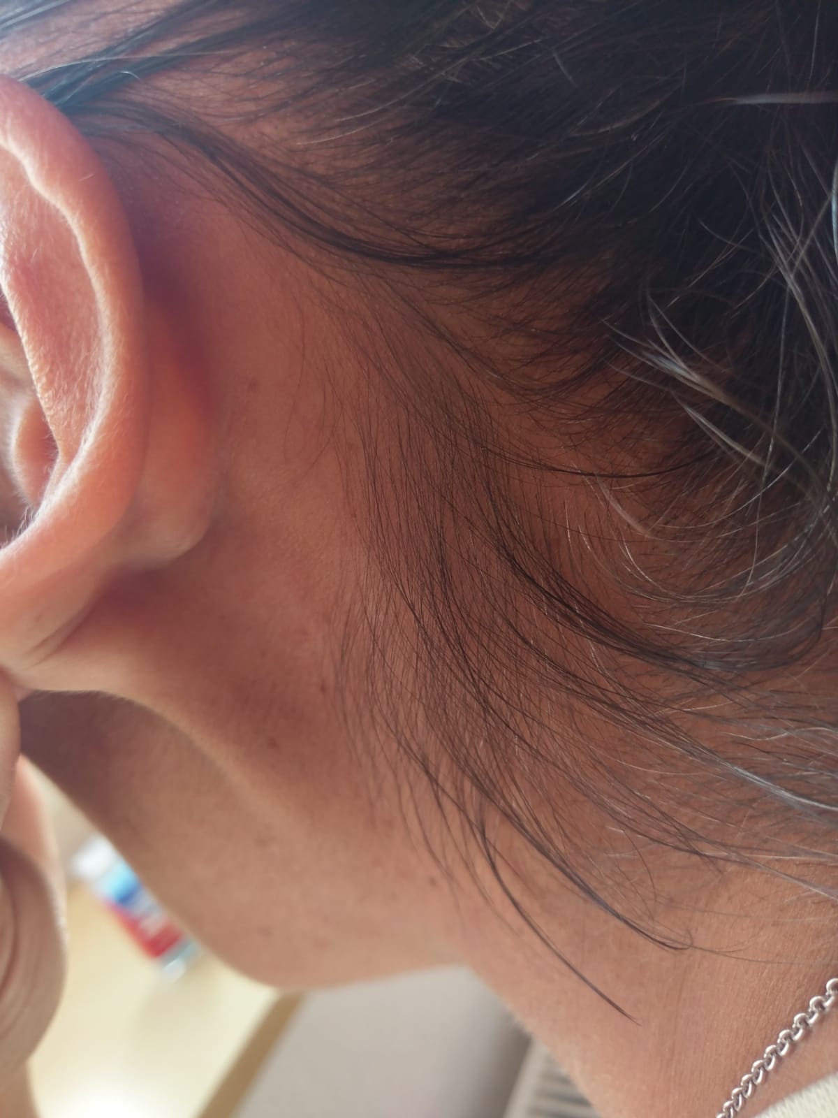 Geschwollener Lymphknoten hinter dem ohr? (Schmerzlos) Geschwollener Lymphknoten hinter dem ohr? (Schmerzlos)