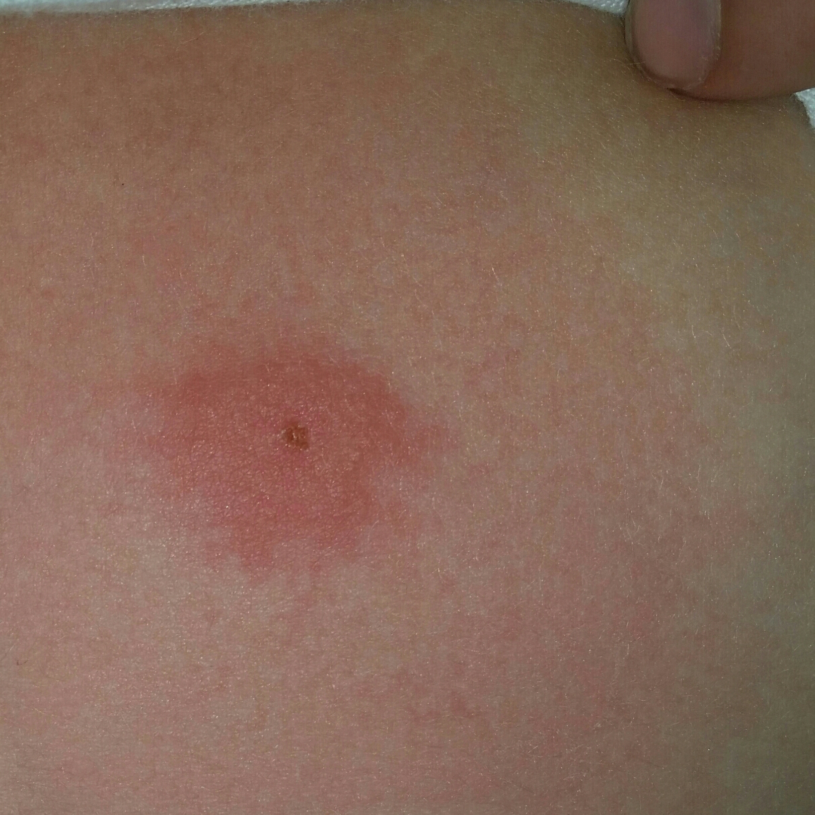 Geschwollener roter Punkt auf der Haut, was ist das? (Medizin, Kinder)