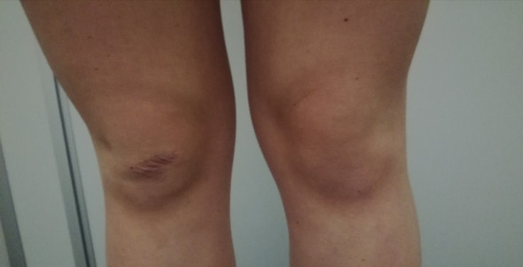 Geschwollenes Knie Was Kann Das Sein Knieschmerzen Geschwollenes Knie Was Kann Das Sein Knieschmerzen