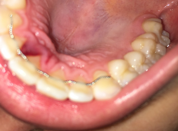Foto der dunkelroten schwellung - (Krankheit, Zahnmedizin)