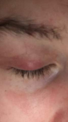 Geschwollenes Und Rotes Augenlied Was Hilft Gesundheit Und Medizin Augen Rot Geschwollenes Und Rotes Augenlied Was Hilft Gesundheit Und Medizin Augen Rot
