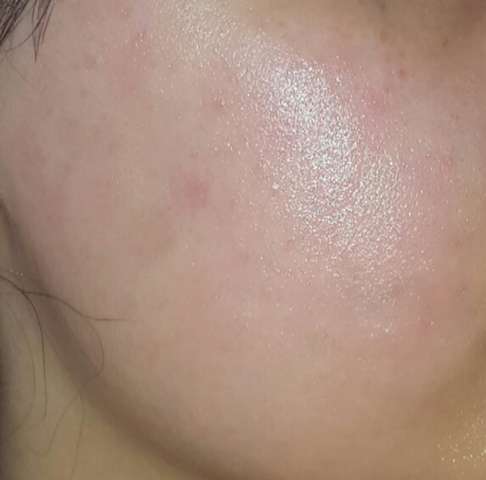 Gesicht Total Rot Und Brennt Allergische Reaktion Oder Nur Hautirritation Siehe Bild Gesundheit Und Medizin Gesundheit Haut