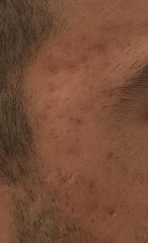 Gesichtspflege Und Narben Manner Pickel Gesicht