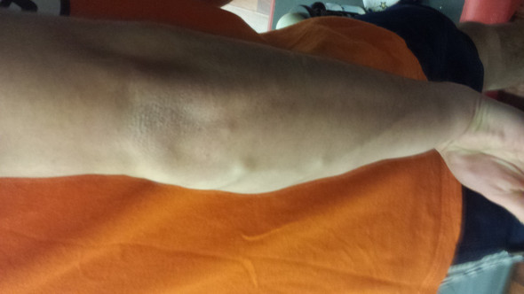 Trombose Im Arm / Thrombosis abgeleitet) ist eine gefäßerkrankung oder Trombose Im Arm / Thrombosis abgeleitet) ist eine gefäßerkrankung oder