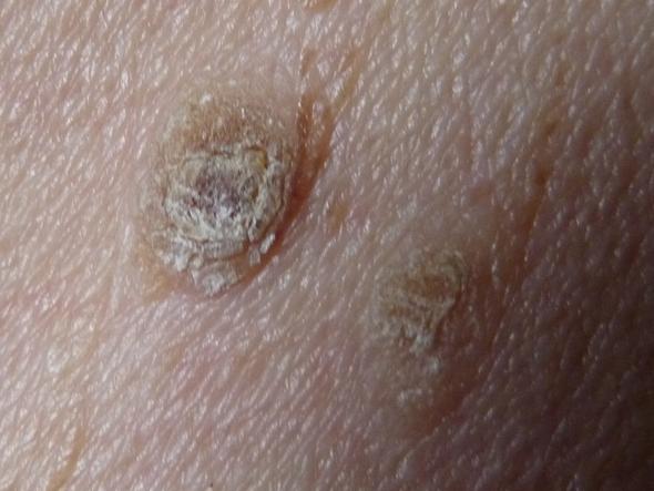 Gewächs auf der Haut Wer kann es grob einschätzen? (Warzen)