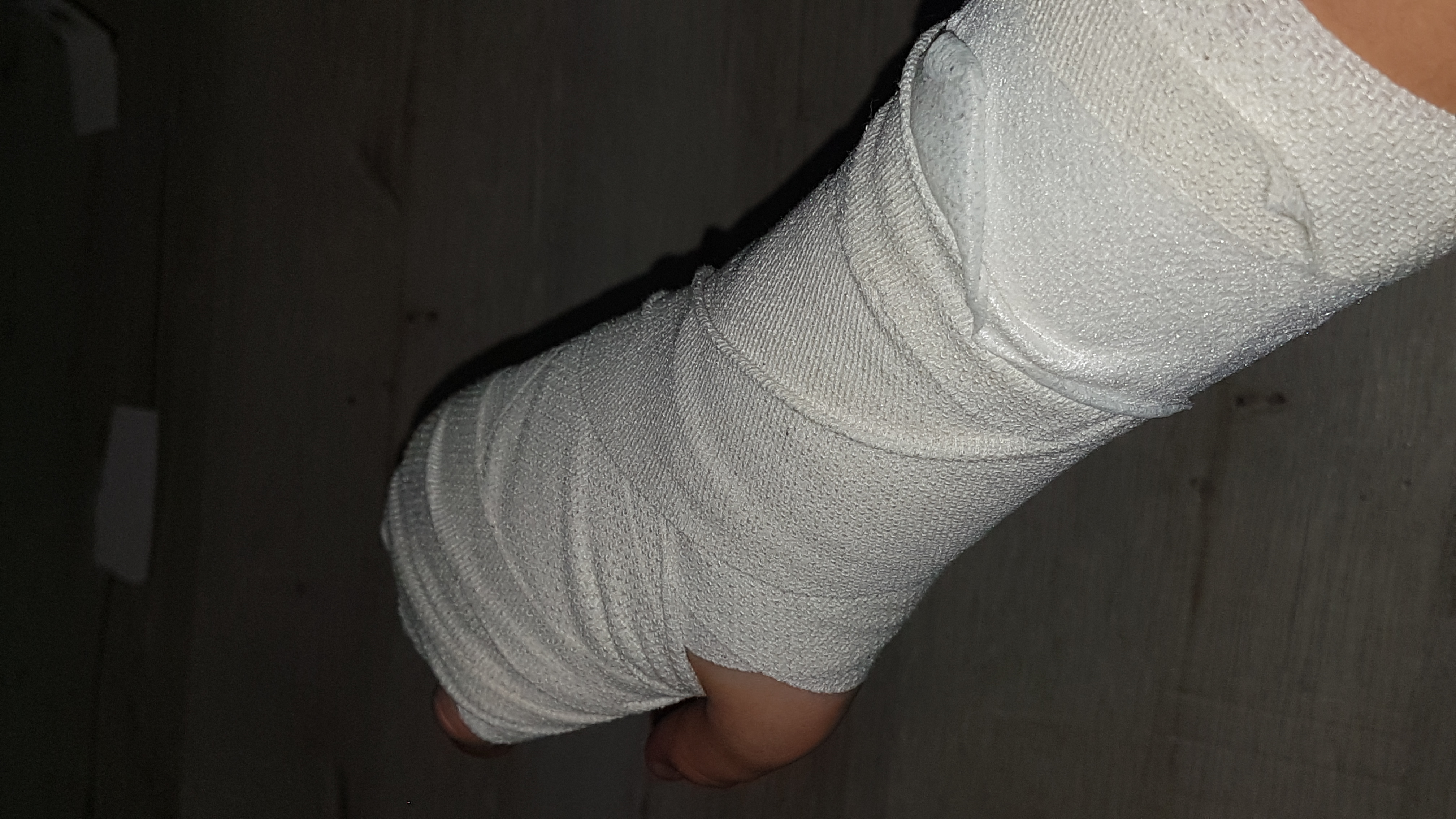 Gips bei Sehnenscheidenentzündung normal? (Gesundheit und Medizin)