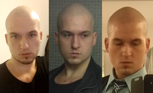 Glatze Sieht Es Ok Aus Siehe Bilder Bewertung
