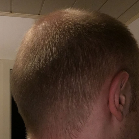 glatze millimeter schnitt haare friseur haarausfall