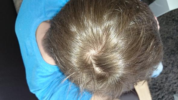 Glatzenbildung Haarausfall Wirbel