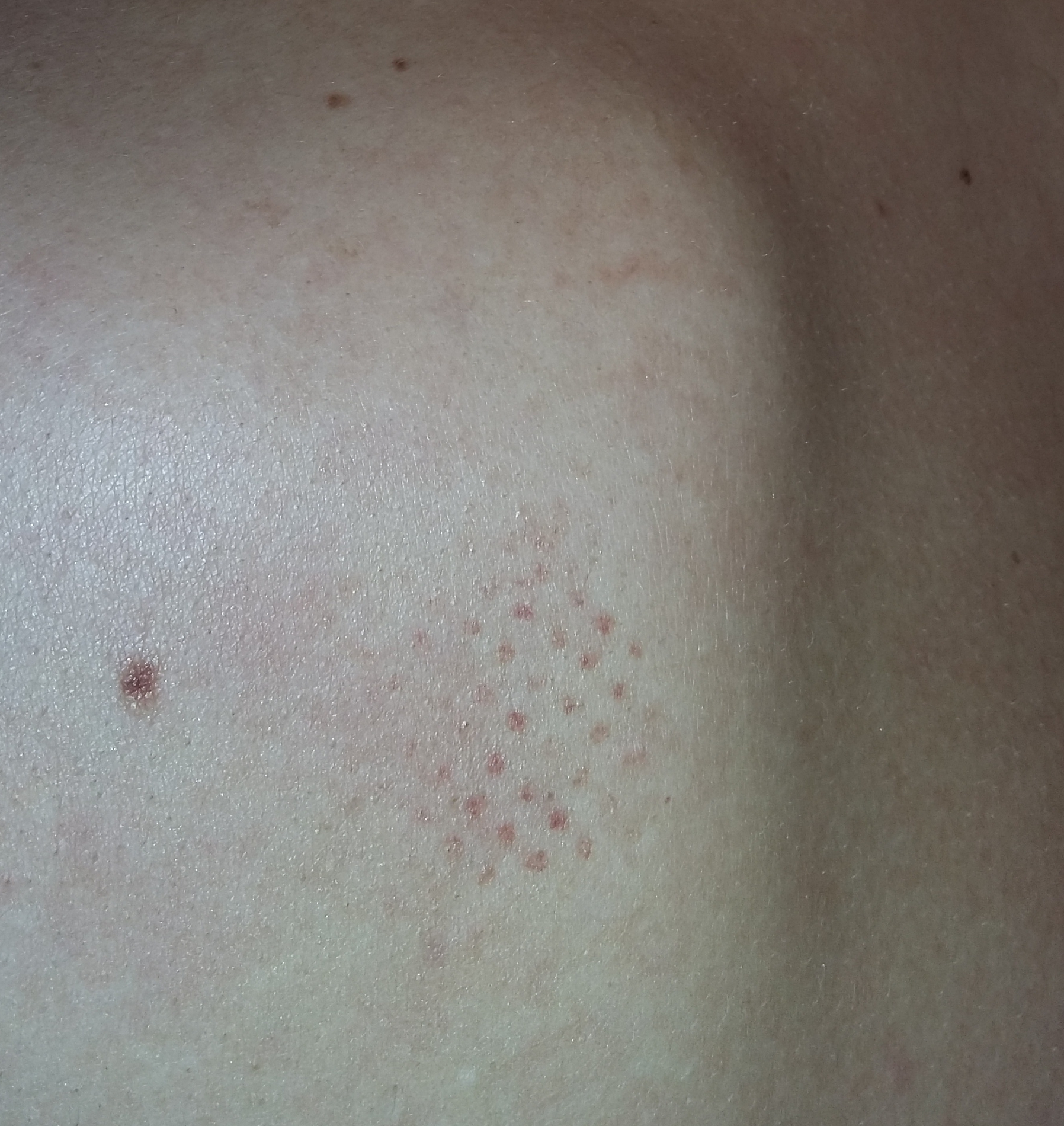 Gleichmäßig verteilte rote Punkte auf der Haut (mit Bild), immer nach
