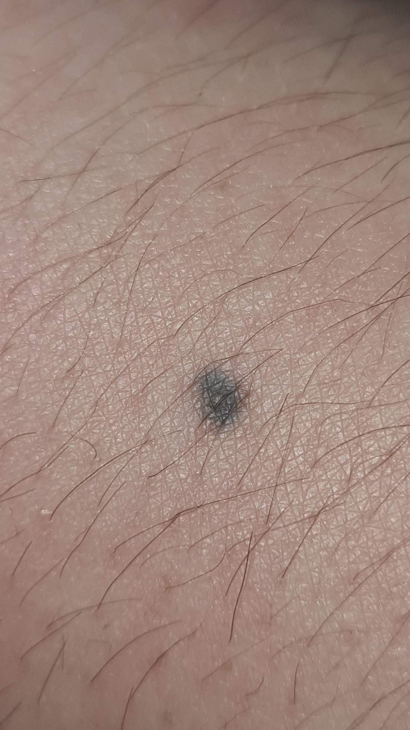 Grau/blauer Punkt am Arm - was könnte es sein? (Gesundheit, Haut)