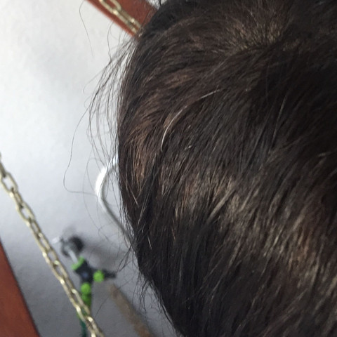 Graue Strähne mit 19 jahre  - (Haare, Krankheit, Aussehen)