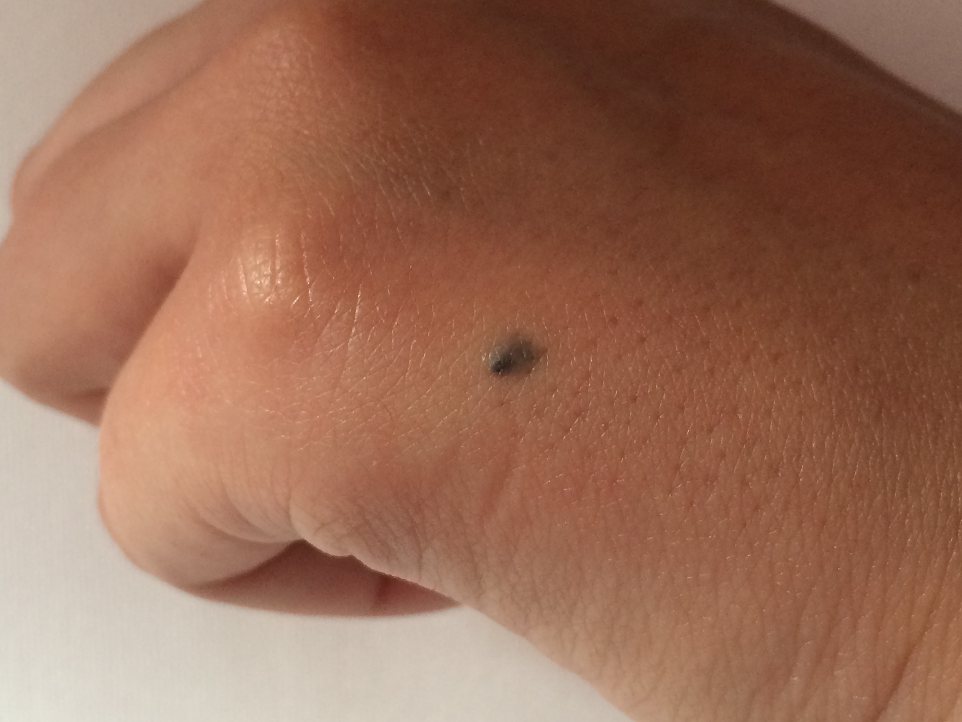 grauer Fleck an der Hand was könnte es sein? (Gesundheit, Haut, Leberfleck) grauer Fleck an der Hand was könnte es sein? (Gesundheit, Haut, Leberfleck)