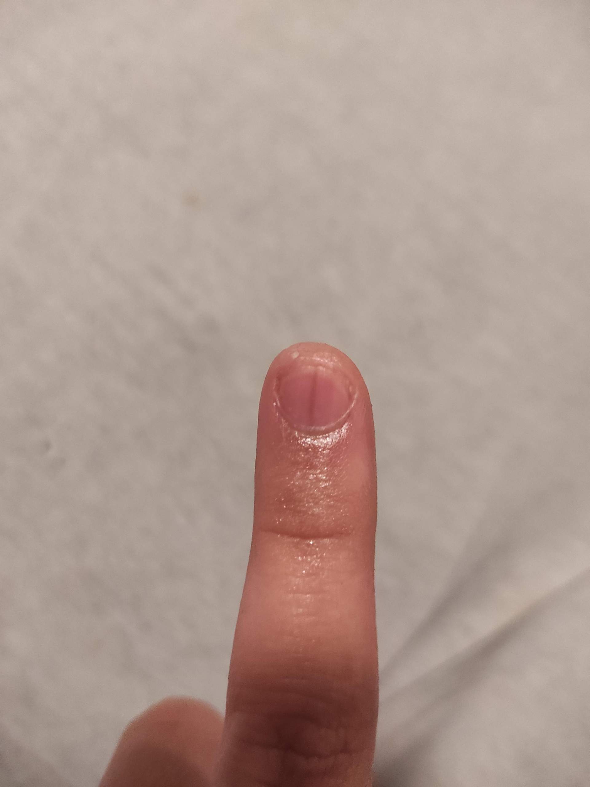 Hautkrebs Schwarze Streifen Im Fingernagel