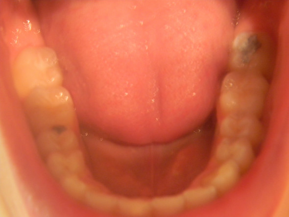 Unten - (Zähne, Zahnarzt, graue Stellen)