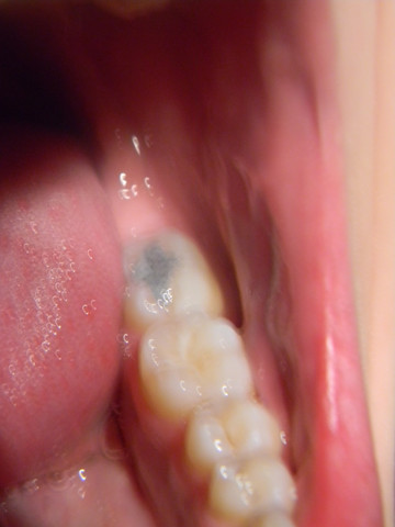 hinten - (Zähne, Zahnarzt, graue Stellen)