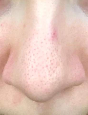 Grosse Poren Hautpflege Unreine Haut