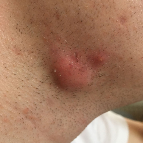 Grosse Beule Am Hals Mit Bild Eklig Gesundheit Und Medizin Pickel Akne Grosse Beule Am Hals Mit Bild Eklig Gesundheit Und Medizin Pickel Akne
