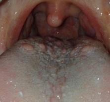 Grosse Blaschen Auf Der Zunge Medizin Blaeschen Grosse Blaschen Auf Der Zunge Medizin Blaeschen